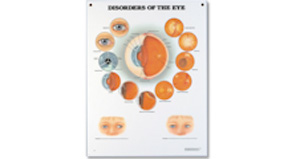 Disorders of the Eye